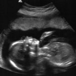 szívhangrendelet, abortusz, magzat